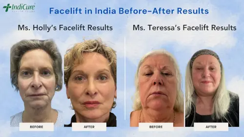 Facelift in India Before-After Results